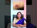Hickey Emergency Do This for Quick Healing Dr Radha Subramaniyan