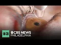 Philadelphia doctors warns of painful eye drop nail glue mixup in viral TikTok