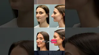 طلقت زوجي بعد ان غيرت انفي قصص واقعية عمليات تجميل الأنف عمليات الأنف عمليات تجميل زواج زوجي 