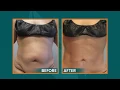 Sono Bello Laser Liposuction Tummy Mini Tummy Tuck
