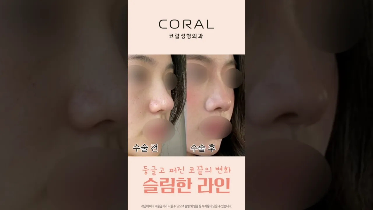 둥글고 퍼진 코끝, 딱 이것만 바꿨는데?!💥 #shorts #코끝성형 #코성형