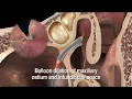 Trans-antral Approach Florida Gulf Coast ENT Naples FL