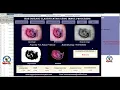 Skin Disease Detection Using Image Processing Detection of Skin Disease Using Matlab Code