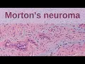 What is a Morton s Neuroma - Pathology mini tutorial