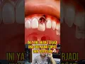 Download Lagu HATI HATI JIKA GIGI COPOT SAMPAI TERTELAN #kisahnyata #fakta