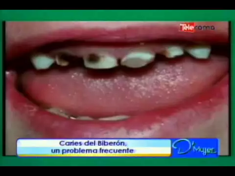 Caries de biberón un problema frecuente