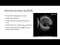 IVUS basics and image interpretation