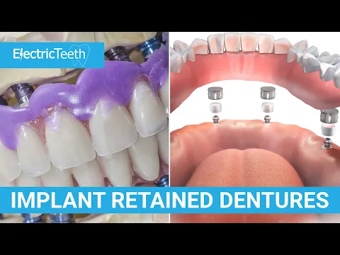 Implant retained dentures explained
