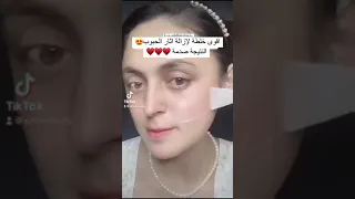أقوى خلطة لازالة اثار الحبوب النتيجة صدمه  أقوى خلطة لازالة اثار الحبوب النتيجة صدمه
