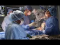 Mount Sinai Spotlight Inspire Therapy Surgery For Sleep Apnea
