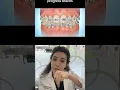 How Can Orthodontic Elastics Help With Your Braces