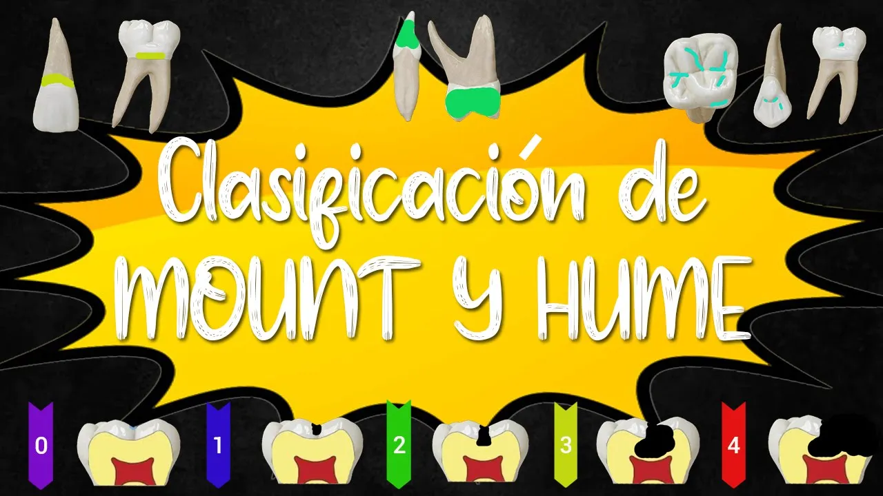 🦷CLASIFICACIÓN DE MOUNT Y HUME Fácil de entender GUÍA DEFINITIVA - BIEN EXPLICADA