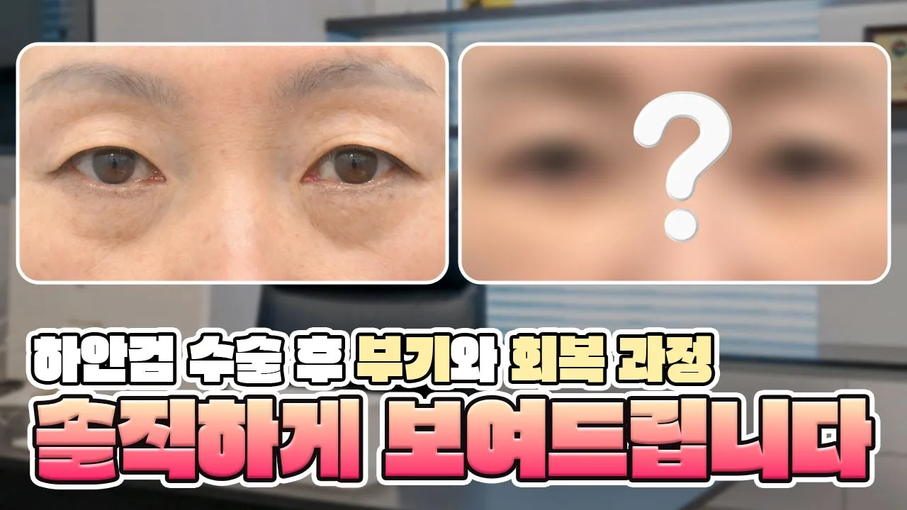 하안검 수술 후 부기와 회복 과정, 솔직하게 보여드립니다.