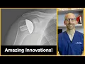 Amazing innovations in shoulder replacement surgery