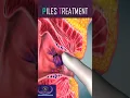 Download Lagu Piles Treatment #shorts #piles