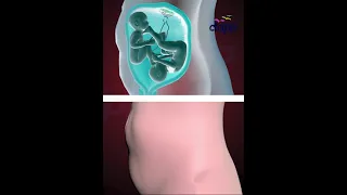TWINS STRUGGLING TO SURVIVE INSIDE THE WOMB 3D ANIMATION