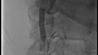 Alphenix Angiography Canon Medical Systems USA 4 