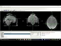 Normalization to the MNI Space and Smoothing SPM Resting-State fMRI Preprocessing MATLAB