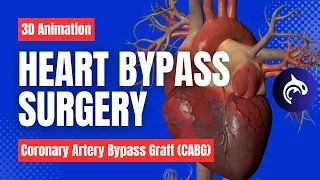 Heart Bypass Surgery (Coronary Artery Bypass Graft CABG) - 3D Animation