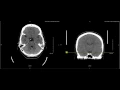 Unremarkable Non-Contrast CT Axial Scan - Example 2