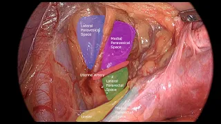 Uterine artery ligation and anatomy of pelvic spaces
