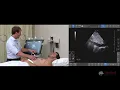 Examining the Inferior Vena Cava IVC with Point of Care Ultrasound POCUS