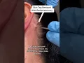 Download Lagu Skin Tag Removal With Radiofrequency | Quick \u0026 Safe Treatment DRMEDISPA
