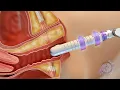 Download Lagu A animation of how the C02re Intima Vaginal Rejuvenation Works