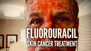 Fluorouracil Skin Treatment – Before, During, and After