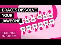 How Do Braces Actually Work