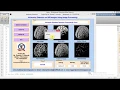 Alzhemier Diseases Detection on MRI Images Using Image Processing Matlab Code IEEE Project