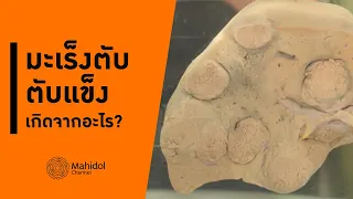 ทำไมการเปลี่ยนตับถึงไม่เหมาะกับทุกกรณีของมะเร็งตับ