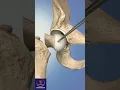 Download Lagu Hip Replacement Anterior Surgery #shorts #education