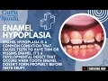 All About ENAMEL HYPOPLASIA Thin Missing Tooth Enamel