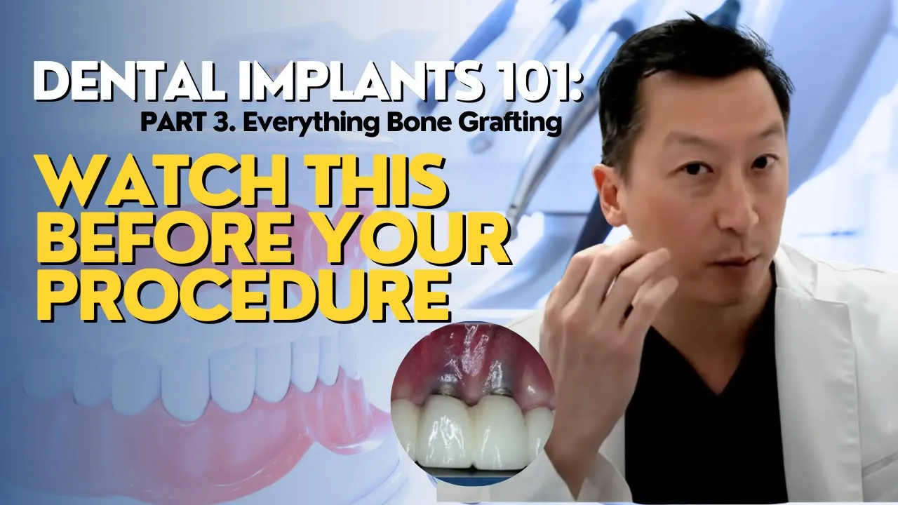Outline Video Dental Implants 101: What You NEED to Know! Part 3 (Everything Bone Grafting)