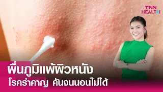 ผื่นภูมิแพ้ผิวหนังเกิดจากอะไรบ้าง