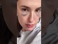Blepharoplasty - 1 Month After