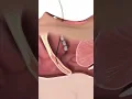 Elevoplasty is a procedure that treats snoring by lifting and stiffening credit Fauquiter ENT YT
