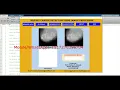 Breast Cancer Detection Using Image Processing With Source Code Matlab Breast Cancer Detection