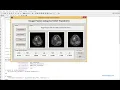 MATLAB code of Image fusion of Medical image using Wavelet Curvelet and Contourlet Transform