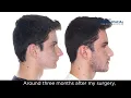 Double jaw surgery Case 73 Pablo - Class 2 Biretrusion overbite short face