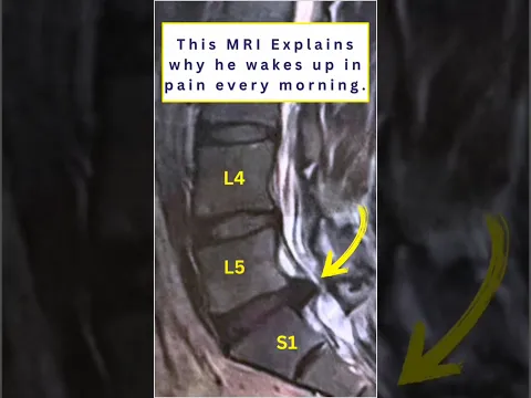 Herniated Disc Worse in the Morning? Do These 3 Things
