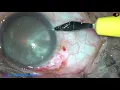 Download Lagu SICS for Ophthalmology residents all over the world : Pradip Mohanta, 1st November, 2020