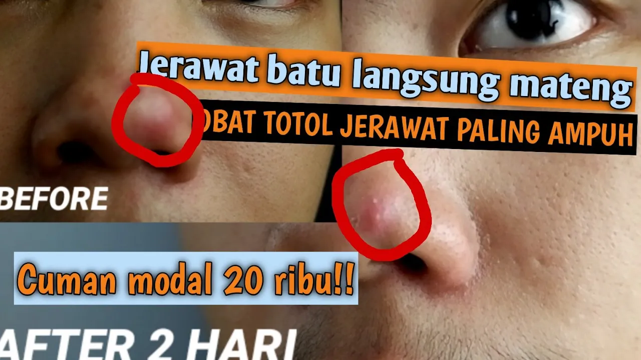 Cara alami menghilangkan jerawat di hidung