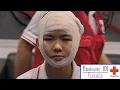 Bandaging 101 - Forehead