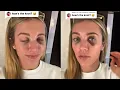 Lexie Hull injury update on her face after collision during the game