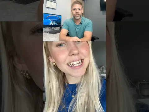 Braces Case Of The Day: Class III (Underbite) with Open Bite And Dental Crowding 🦷