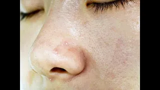 ماسك للبشرة الدهنية إزالة الدهون المتراكمة على الوجه محلول لتنظيف البشرة 