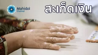 โรคสะเก็ดเงินเกิดจากอะไร และมีปัจจัยใดที่ทำให้ผื่นแย่ลงบ้าง