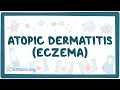 Atopic dermatitis eczema - causes symptoms diagnosis treatment pathology